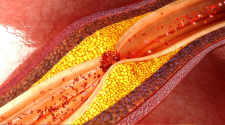 Tam tıkalı kalp damarlarında ameliyatsız çözüm