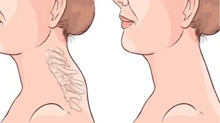 "Buffalo Hump" olarak bilinen ense hörgücü büyük sağlık riski oluşturuyor