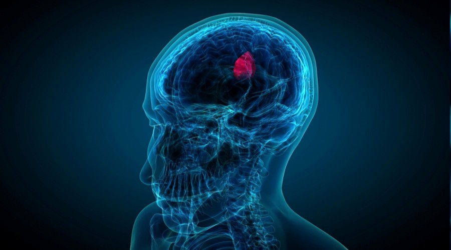 ‘MS çaresiz bir hastalık değil’