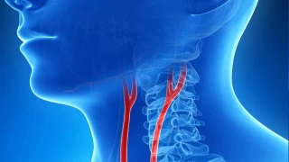 Şah damarı tıkanıklığı: Sessiz tehlike