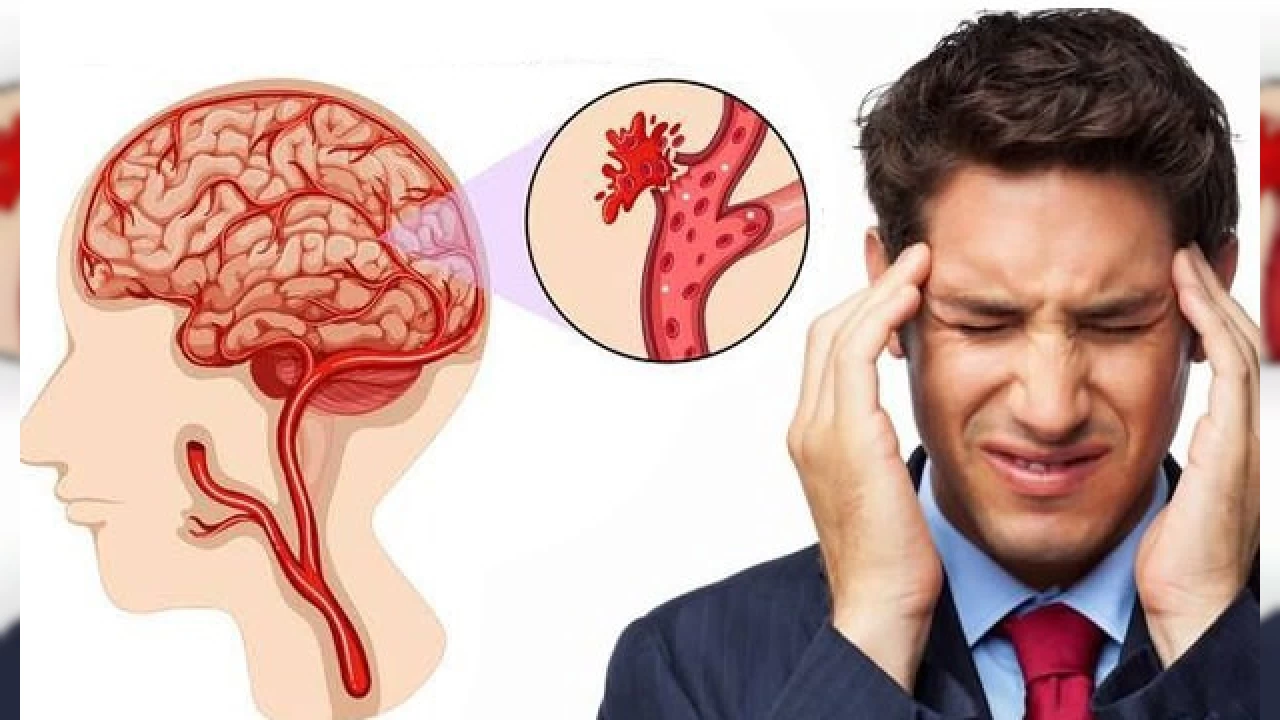 Her yıl 1 milyon kişi beyin kanaması geçiriyor