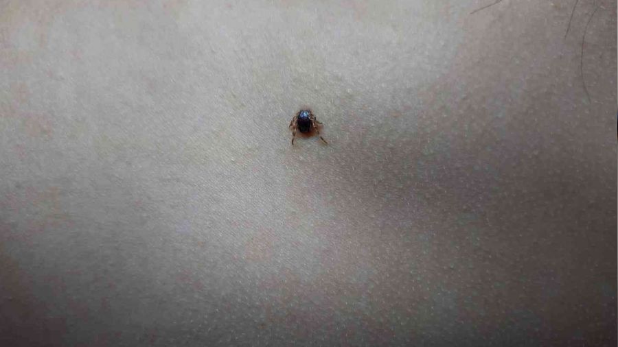 Çocuğun sırtındaki kene hastanede çıkartıldı