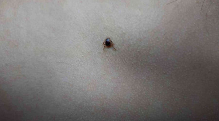 Çocuğun sırtındaki kene hastanede çıkartıldı