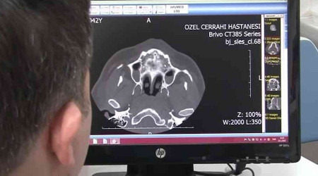 Eksik dişler, ağız ve dil kanserine neden olabiliyor