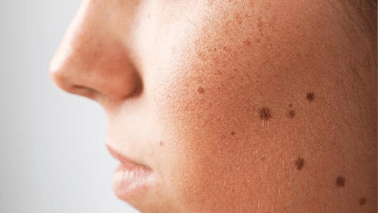 Vücuttaki bazı lekeler, tıbbi bir sorunun belirtisi olabilir
