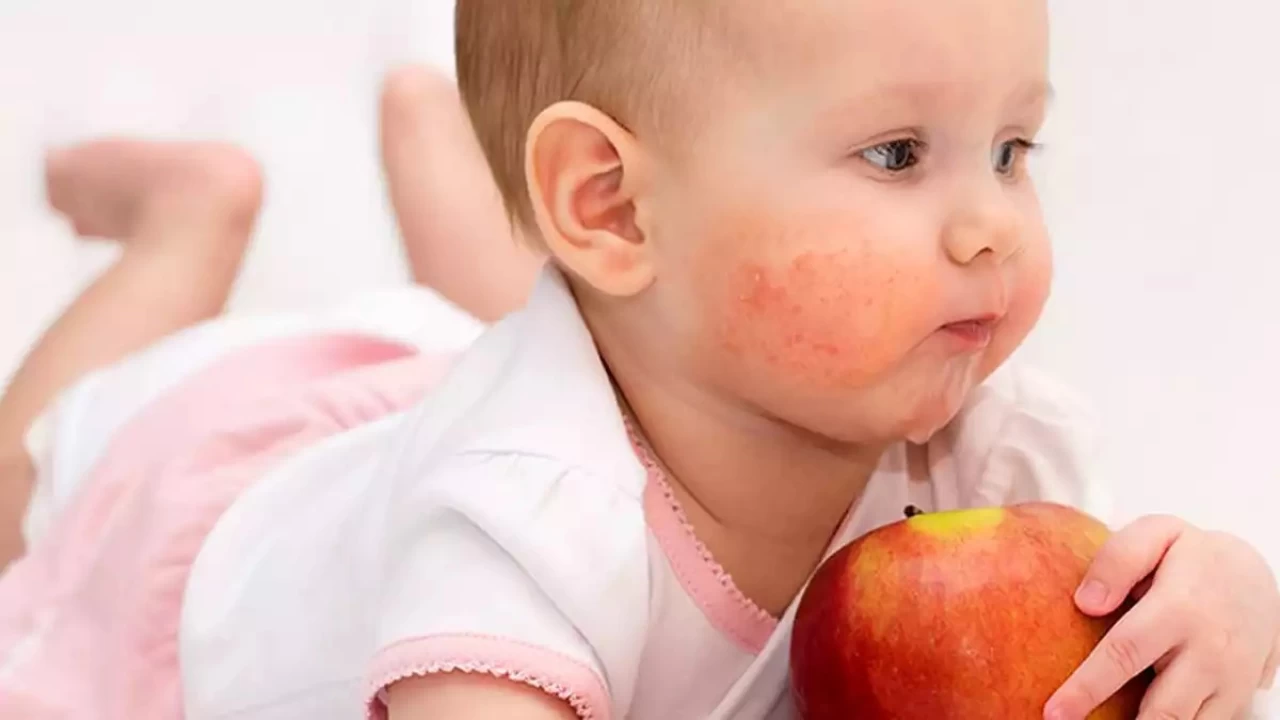 Besin alerjisinde artış var