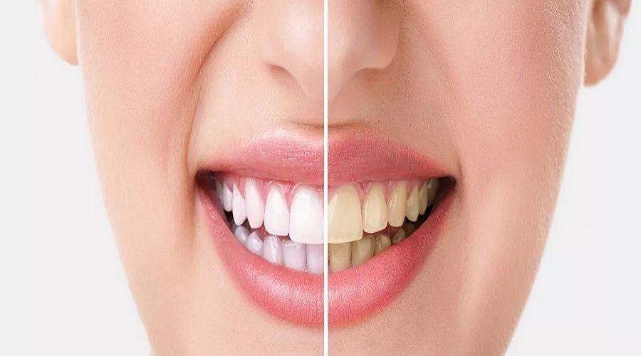 Dişler neden renk değiştirir?