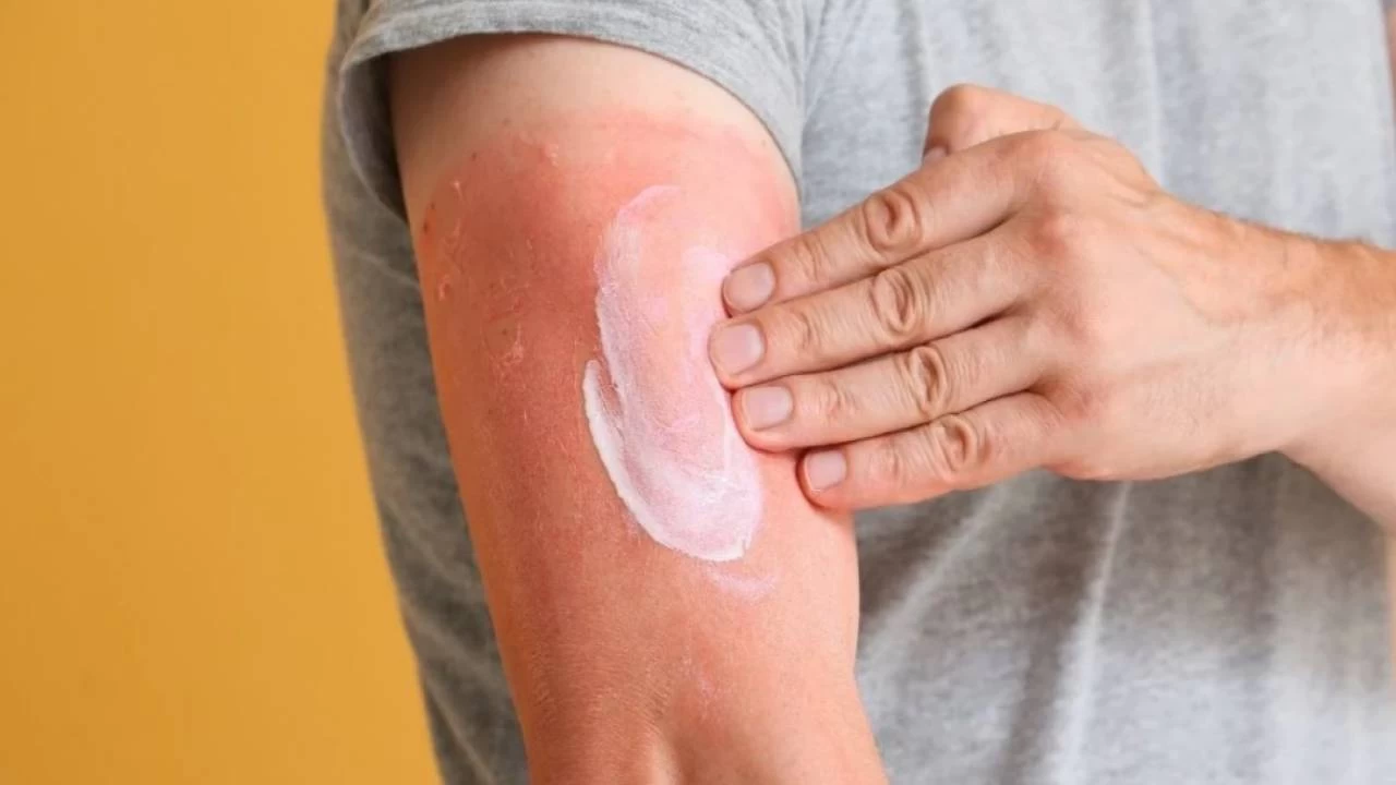 Güneş yanığına karşı doğal tedavi yöntemleri