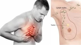 Erkeklerde Meme Kanseri: Az Bilinen Ama Gerçek Bir Hastalık