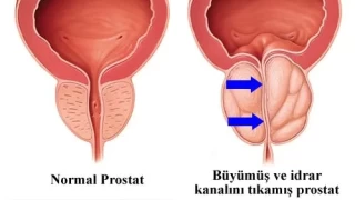 Prostat hastal ve tedavisi