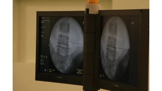 Fıtık Nedir? Çeşitleri Nelerdir?