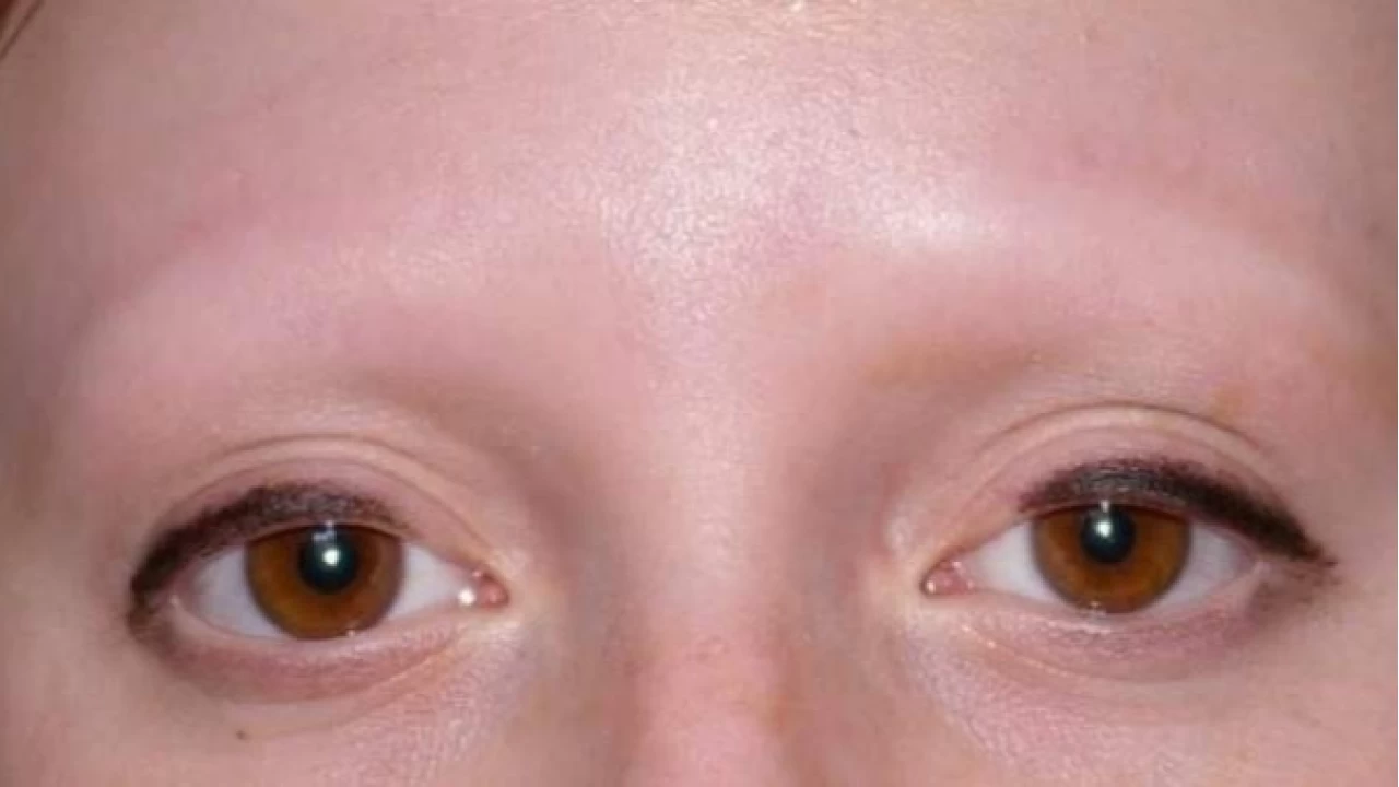 Kaş dökülmesinin nedenleri: Güzelliğin sessiz alarmı