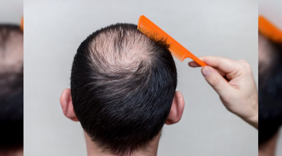 Saç ekiminde tehlikeli durum