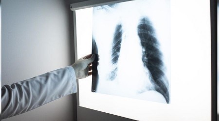 Verem hala tehlikeli bir hastalık