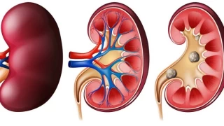 Bbrek talar: Oluumu, belirtileri ve tedavisi