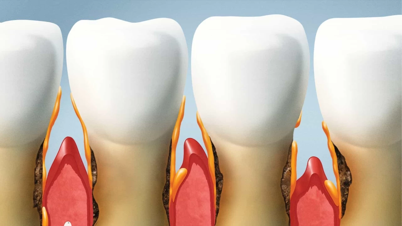 Diş Eti Çekilmesinin Nedenleri, Belirtileri ve Tedavi Yöntemleri