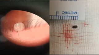 Hastanın gözünde canlı kene çıktı