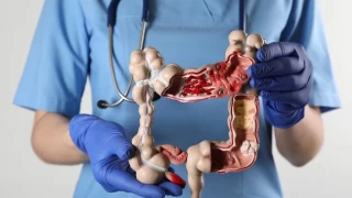 'Az sebze ve meyve tüketimi, kolorektal kansere davetiye çıkarıyor'