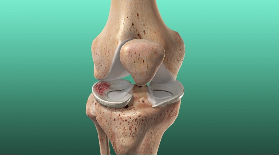 Menisküs yaralanmalarında ciddi artış