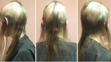 Trikotillomani hastalığı nedir?