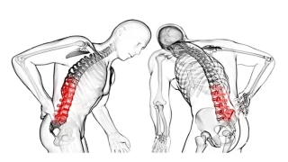 Ankilozan spondilit nedir?