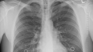 Akciğer kanserinde çevresel faktörlerin etkisi giderek artıyor