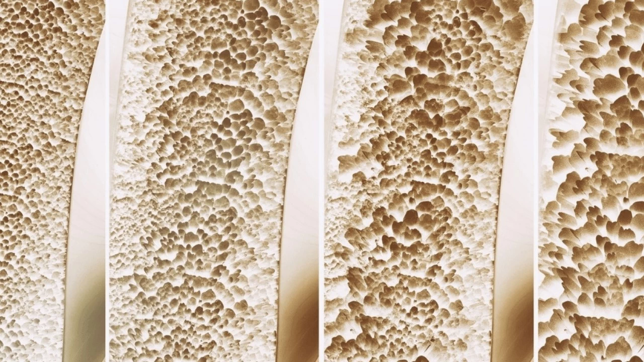 Kemik erimesi: Bilmeniz gerekenler