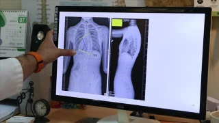 Omurgadaki Yan Eğrilik: Skolyoz Nedir ve Nasıl Önlenir?