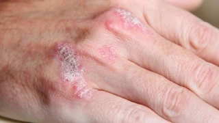 Soğuklarda cilt kuruluğuna karşı 10 tavsiye