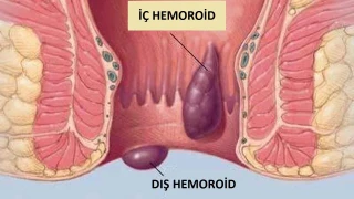 Tuvalette Telefon Kullanmak Basur Nedeni